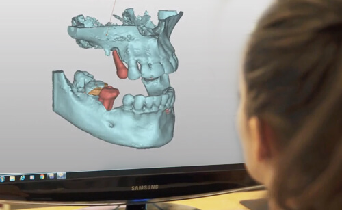 3D Implantatplanung in Sopron